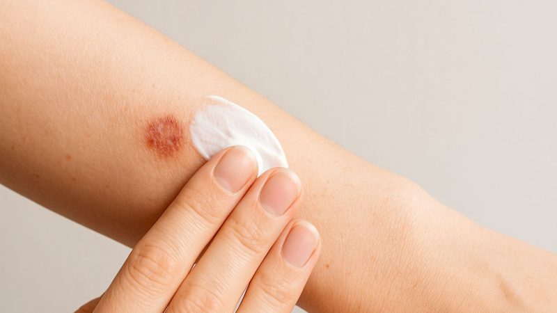 Get rid of chickenpox spots fast: safe, proven steps